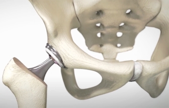 Anterior Hip Arthroplasty, Advancing Hip Replacement Outcomes and Longevity