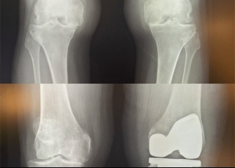 The Comprehensive Joint Replacement Program
