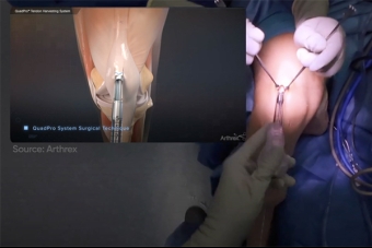 Understanding ACL Reconstruction and Recovery