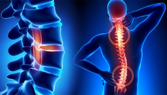 Understanding Adult Scoliosis