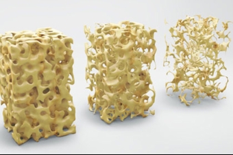 What You Need to Know About Bone Health and Osteoporosis