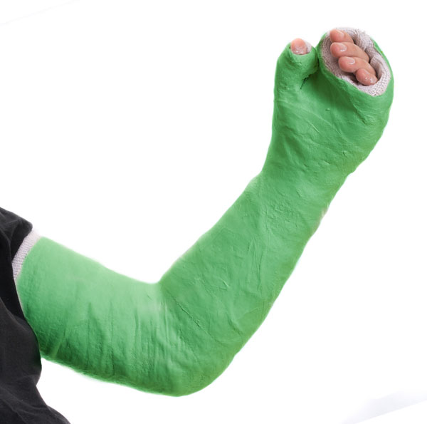 Individual with a cast considering general orthopedics