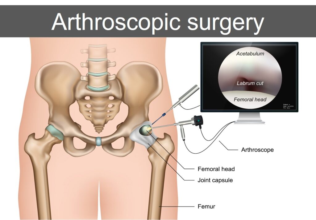 Arthroscopic surgery