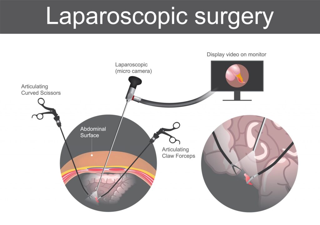 Laparoscopic surgery. Technical surgery which operations are performed far from their location through small incisions in abdominal surface or the body. Large Intestine system. Illustration human body parts.