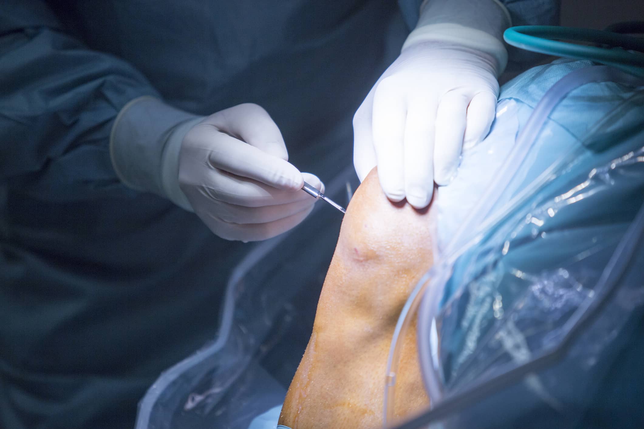 Patient undergoing meniscus tear repair surgery with a doctor at Colorado Springs Orthopedic Group