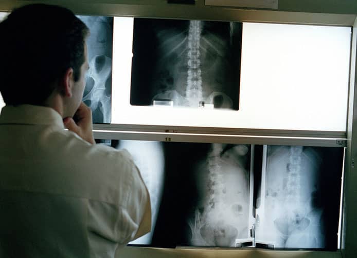 Doctor looking at spine x-rays in preparation for a spinal cord stimulator. 
