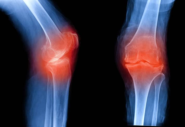 X-ray with red highlighting knee joint pain that requires cartilage restoration procedures.