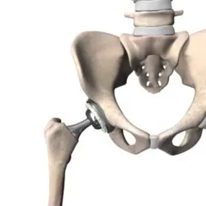 Hip_Implanted-400x400 Hip Image