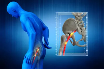 What Is Sciatica? - Legacy Clinic of Chiropractic