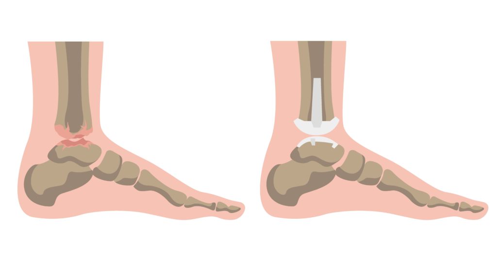 arthritis in the ankle treated with Ankle Replacement vs Fusion