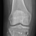 After high tibial osteotomy, the leg is more straight