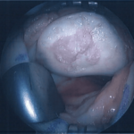 Large cartilage defect under the patella