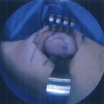 A cartilage graft is placed into the defect