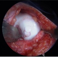 Cartilage Graft Placed Into Defect