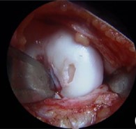 Small Cartilage Defect Of The Medial Femoral Condyle