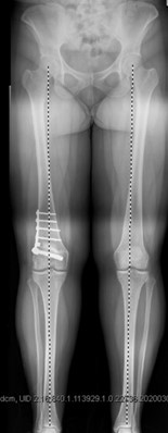 Valgus Malalignment Post Distal Femoral Osteotomy Surgery For Knocked Knee