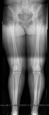 Valgus Malalignment Pre Distal Femoral Osteotomy Surgery For Knocked Knee