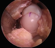 Cartilage Graft Placed Into Defect