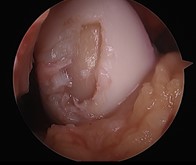 Large Cartilage Defect Of The Medial Femoral Condyle