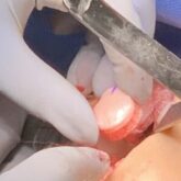 Cartilage Graft Being Placed Into Defect