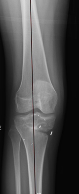 Varus Malalignment Post High Tibial Osteotomy Surgery For Bow Legged Knee