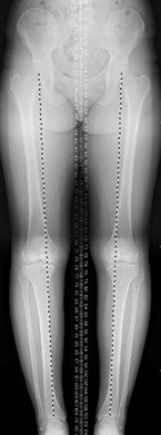 Varus Malalignment Pre High Tibial Osteotomy Surgery For Bow Legged Knee
