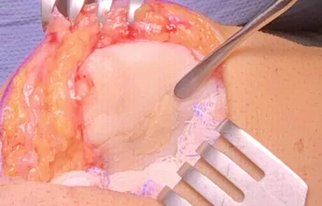 Post Cartilage Resurfacing Of The Patella