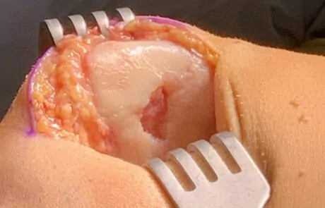Pre Cartilage Resurfacing Of The Patella