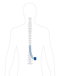 Graphic Illustrating where a spinal cord stimulator is placed on the low back to treat Diabetic Neuropathy