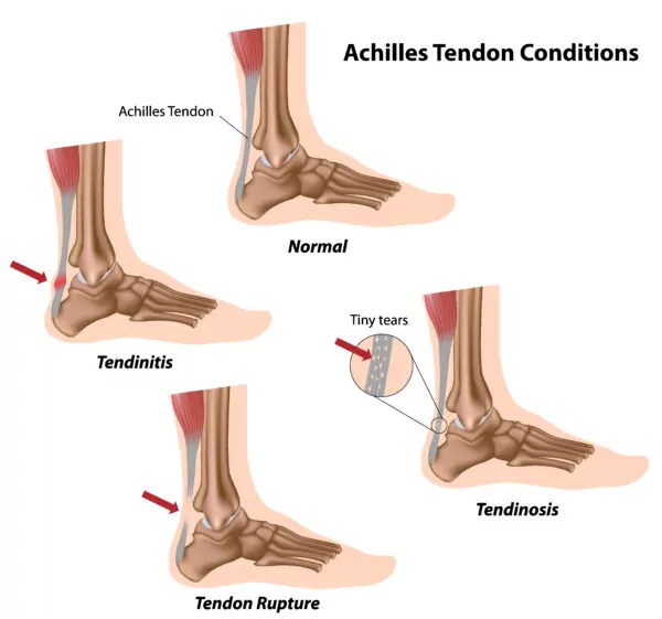 ligaments and tendons of the foot, Ankle anatomy, ankle bones Achilles-Tendon-Conditions