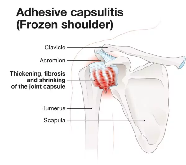 Adhesive-Capsulitis-anatomy-600x531