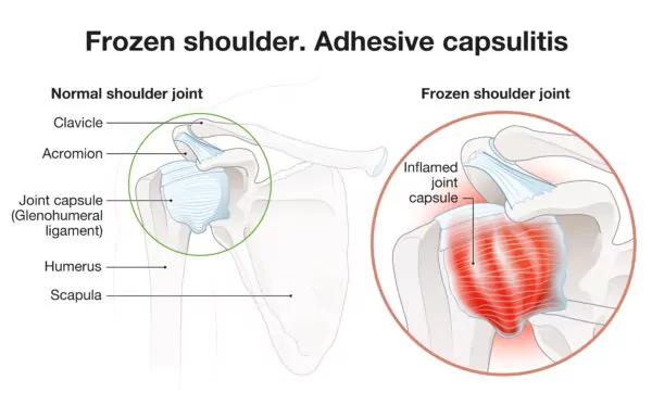 Adhesive-Capsulitis-anatomy-normal-vs-inflammed-600x373