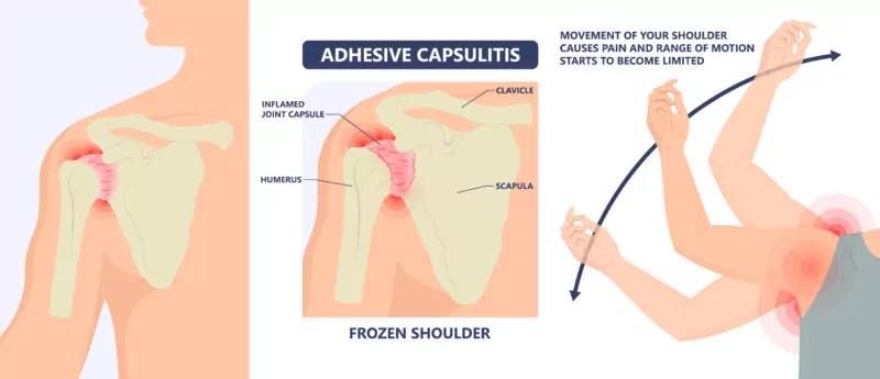 Adhesive Capsulitis