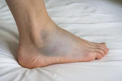 Image of Sprained Ankle Symptoms, localized to low ankle not high ankle sprain