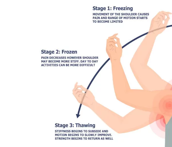 Frozen Shoulder Stages