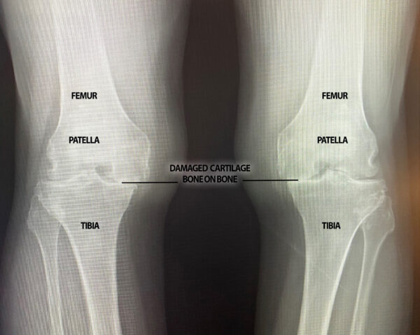 Bi-Lateral-Osteoarthritis-in-Knees-x-ray-with-detail-600x479