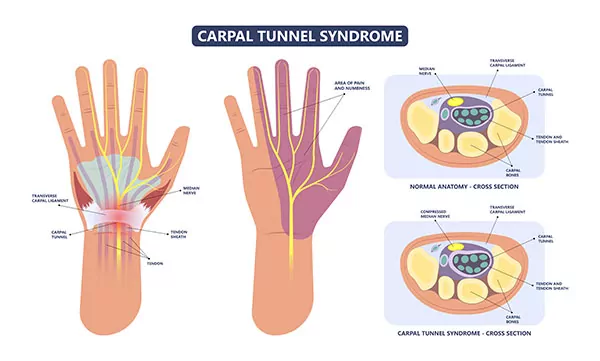 Carpal-Tunnel-Syndrome