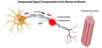Compressed-Neuron-Signal-Transportation