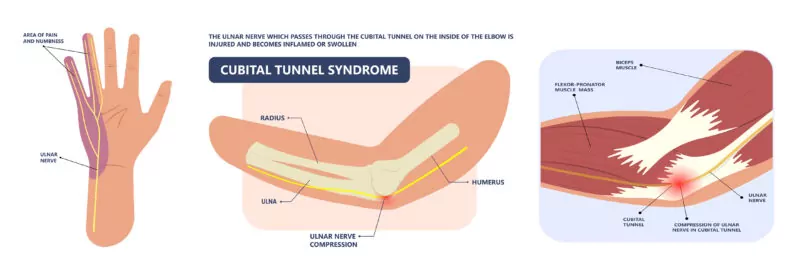 Ulnar Neuropathy at the Elbow (Cubital Tunnel Syndrome) – Neuromuscular and  Electrodiagnostic Clinic