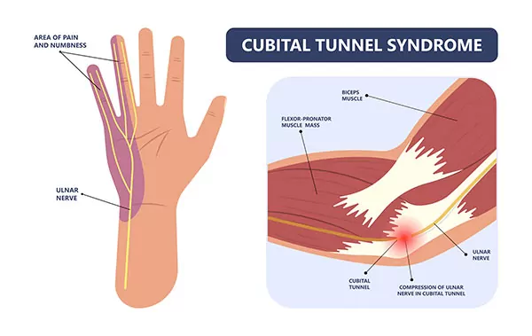 Cubital-with-Muscle-Illustration