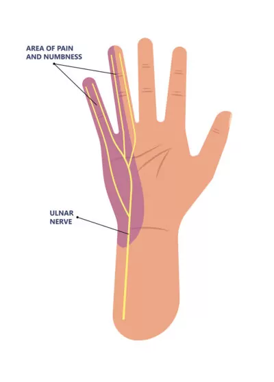 Hand-Numbness-Symptoms