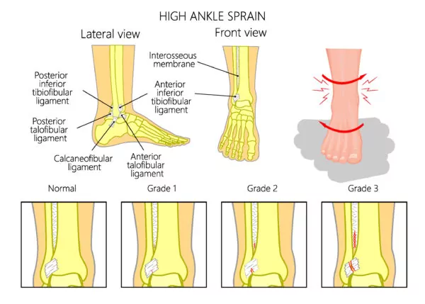 Sprained Ankle Types. Example of High Ankle Sprain from the lateral view and front view detailing grades of ankle sprains