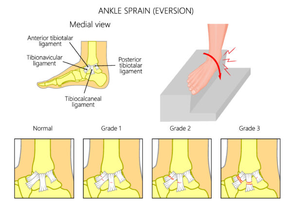 Low-Eversion-Ankle-Sprain-Grade-Graphic-600x429