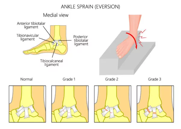 low eversion ankle sprain including various grades of low ankle sprains and how an ankle sprain can occur