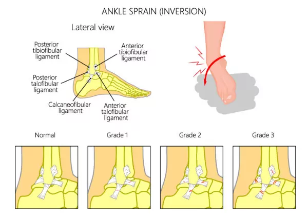 Low-Inversion-Ankle-Sprain-Grade-Graphic-600x429