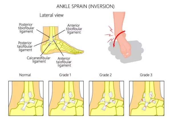 Low inversion ankle sprain from lateral view. Including grades of ankle sprains