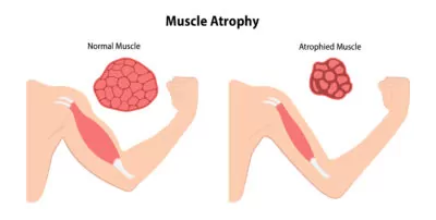 Muscle Atroph