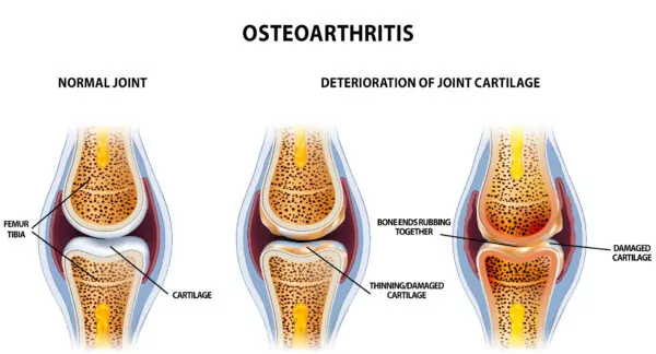 Osteo-Progression-600x324