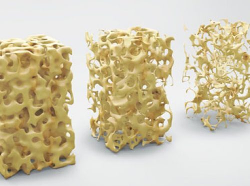 Osteoporosis Visual Aid Banner Image