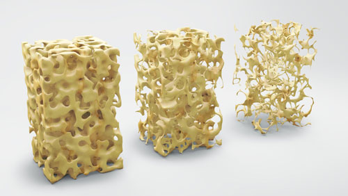 Osteoporosis Visual Aid